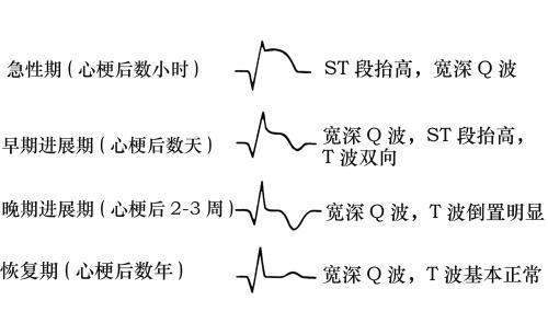 原创上午心电图和心肌酶都正常晚上人就没了专业医生找到原因