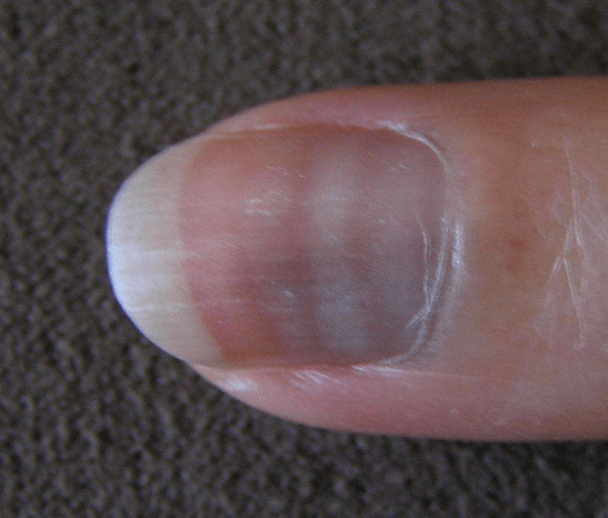 原创指甲出现这3种变化可能是肾脏的求救信号及时去医院排查