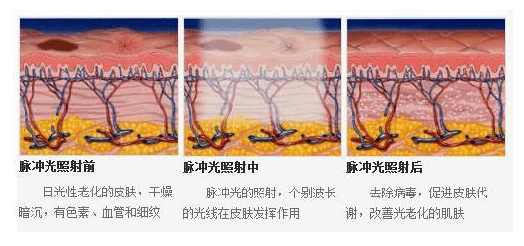 王主任经常做光子嫩肤，皮肤会变薄吗?