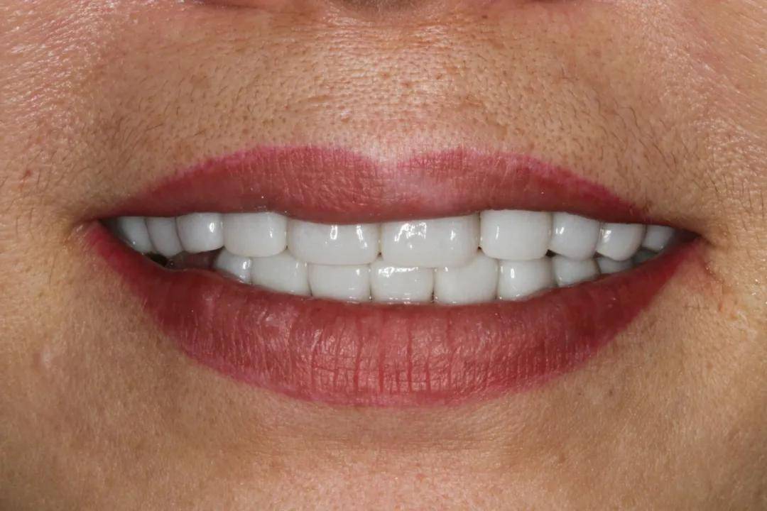 绚彩3dpro临床病例展示丨氧化锆贴面治疗四环素牙一例