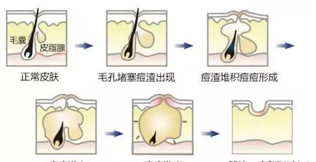 痘痘坑怎么办