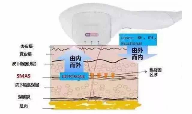 脸部天啊~做完超声刀脸凹陷了怎么办？超声刀后脸部凹陷如何修复？该注意什么？