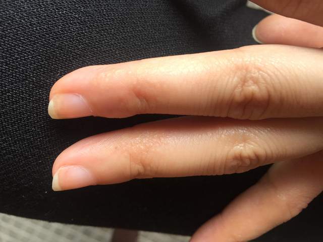 原创23岁女孩手上起小水泡有照片很痒怎么回事