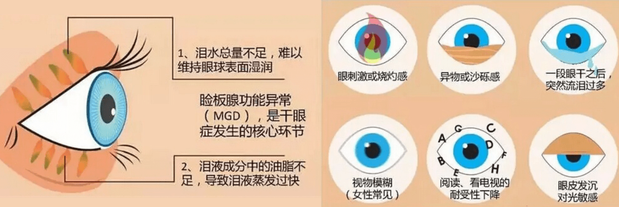 儿童近视高发,成年人干眼症已盯上"儿童"!