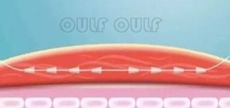 脸部谁知道刚做完线雕脸部有凹凸正常吗?蛋白线面部提升后遗症,好恨!!