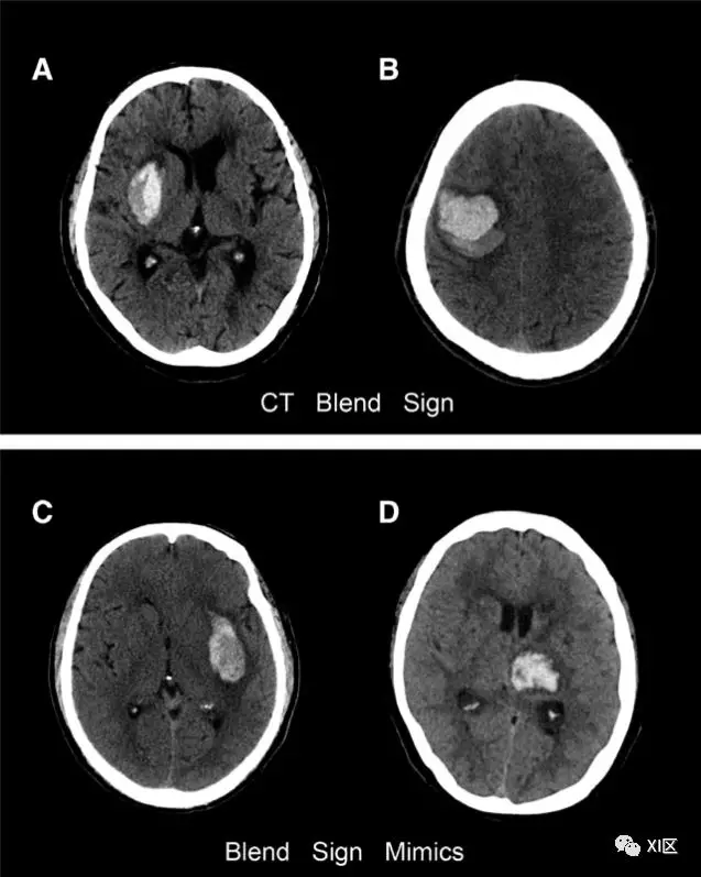 ct圖像中腦出血血腫擴大的十個徵象上