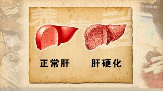 原性|肝硬化病人为什么会出现浮肿的症状?广州和谐医院宋红生专家来给大家解答一下