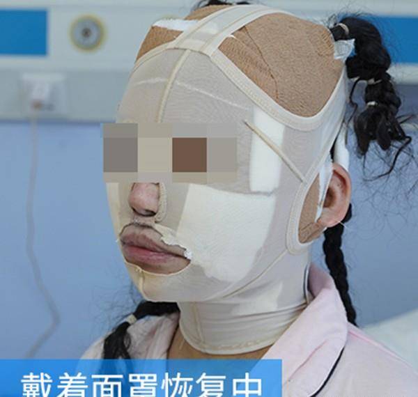 脸部拉皮术后20天记录：从松弛大妈到年轻小姐姐，我经历了什么？