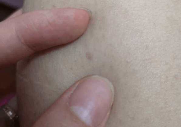 春季皮肤痒,可不是过敏,身体出现4个症状,要及时查hpv