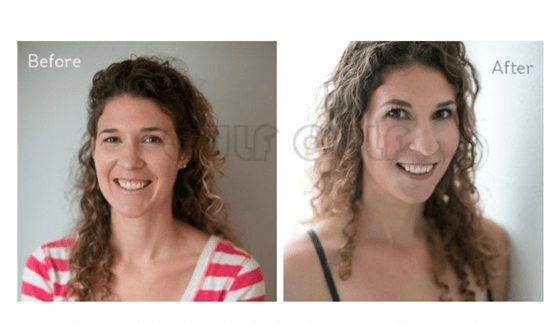 能量求解:蛋白线真的能去皱纹吗,为啥线雕完三个月脸又松弛了?