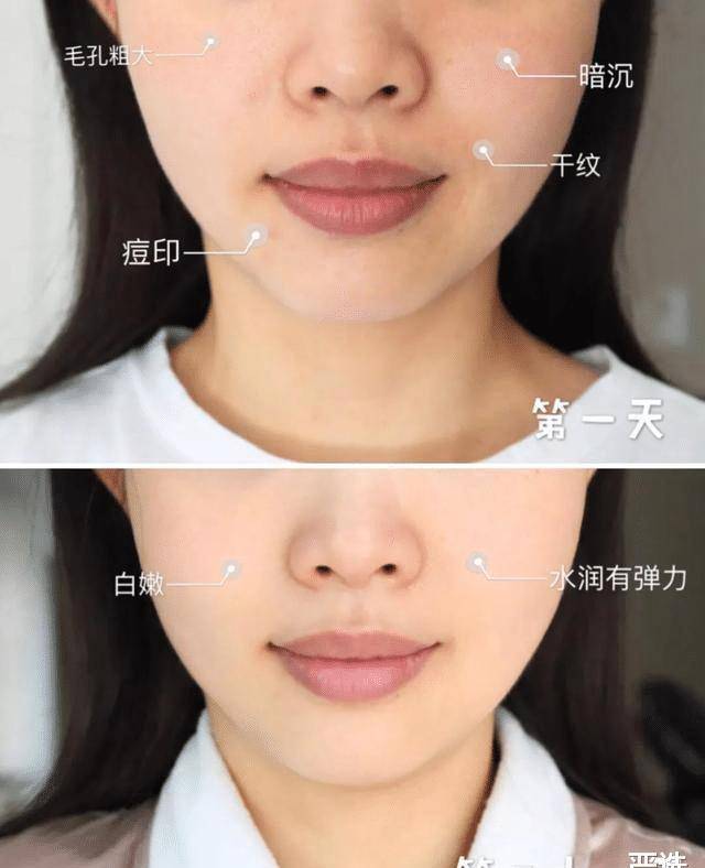 品牌继注射“玻酸”后，又一“抗衰老”方式走红，即安全还方便