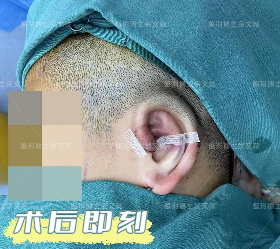 分析】11岁的重度杯状耳患者,采用耳再造直埋法修复_软骨_耳廓_手术