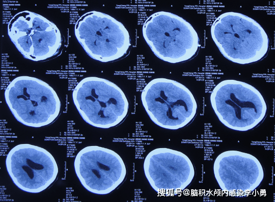 小腦扁桃體下疝畸形合併脊髓空洞行減壓術後出現頭痛發熱腦積水