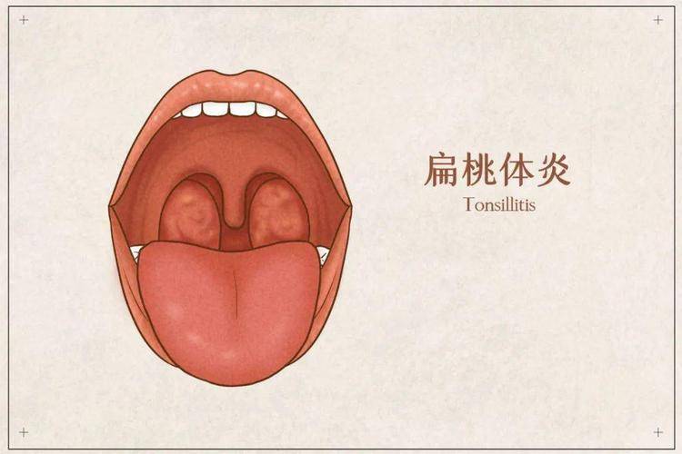 扁桃體發炎分為多種情況南昌博大耳鼻喉