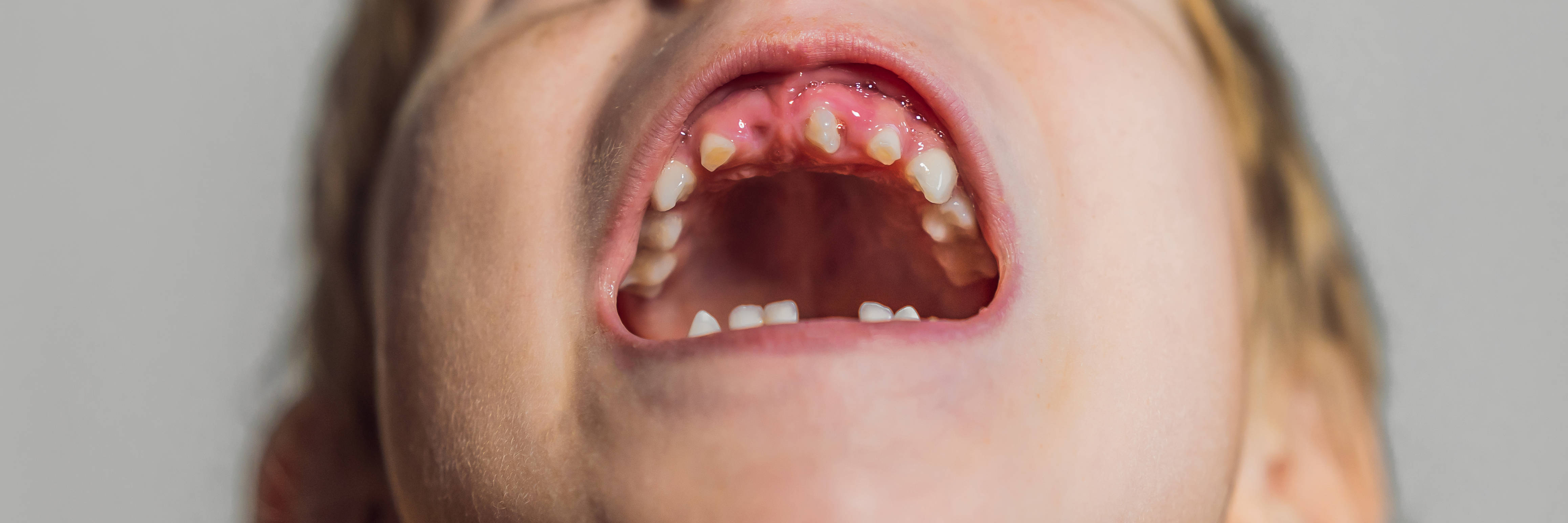 建议|孩子牙齿如果有这些问题，建议赶紧做牙齿矫正，越早做效果越好