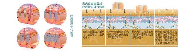 人群2022年求美者“宠儿”，黄金微针VS点阵激光丨咨询师必备