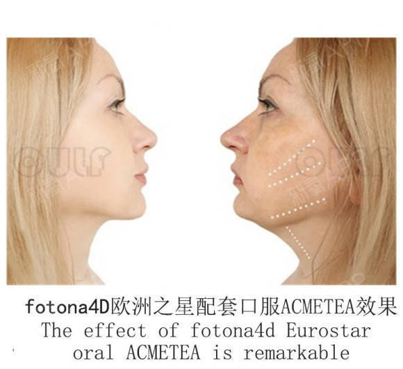 才有关于fotona4d做一次维持多久？fotona 4d效果维持多久做过了才有话说