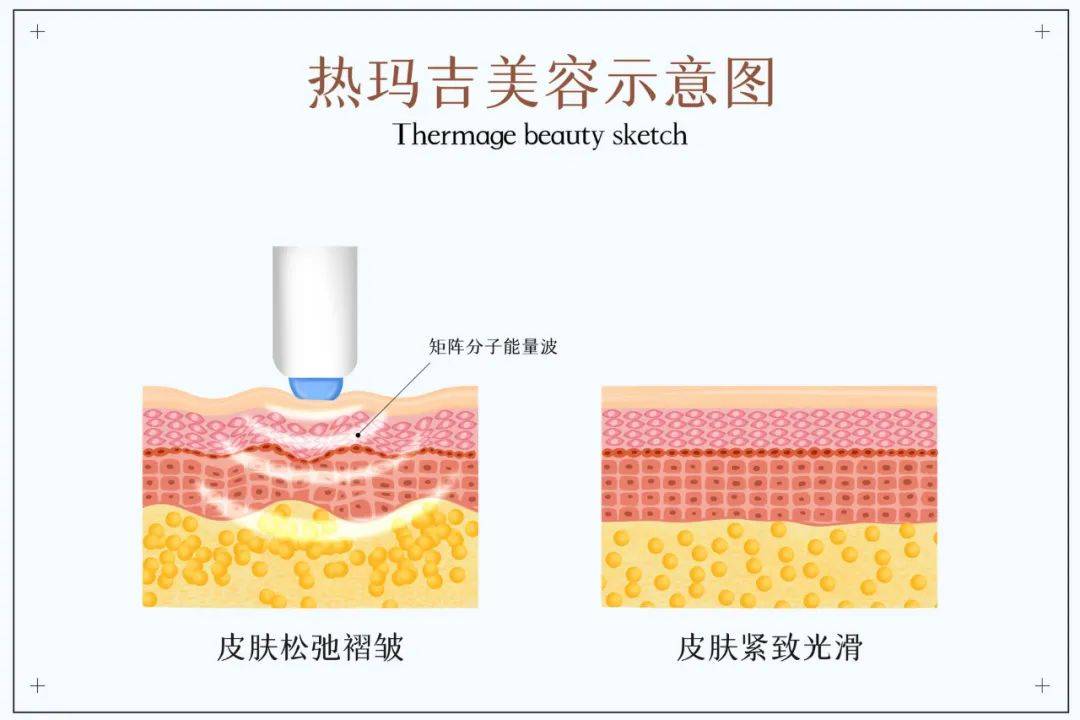 玛吉三个医美项目：水光针、光子嫩肤、热拉提