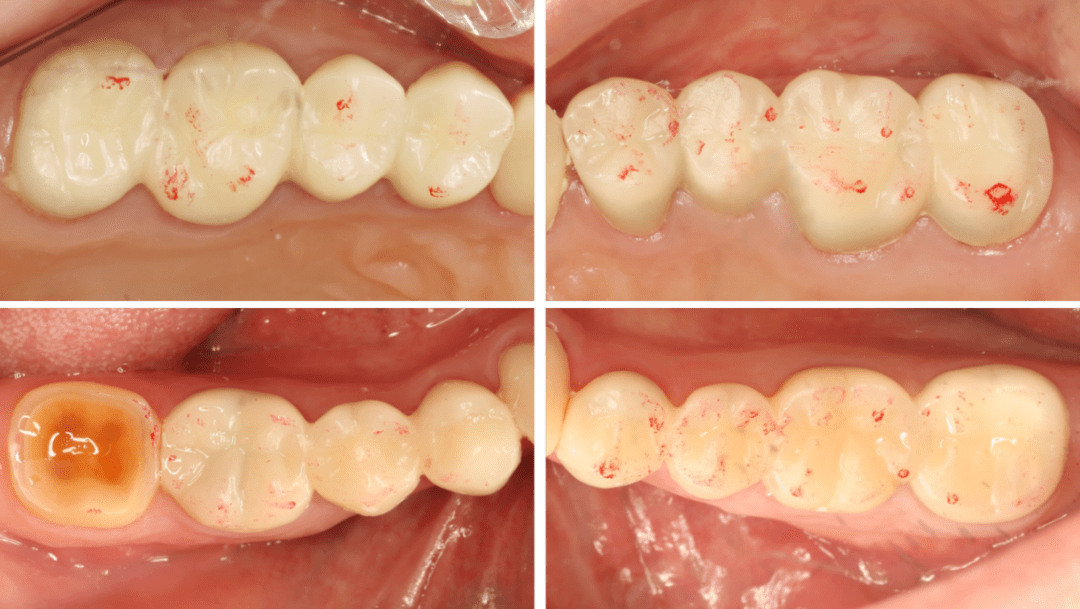 骨关节病合并牙列重度磨耗患者的咬合重建 | 第七届口腔跨学科优秀病