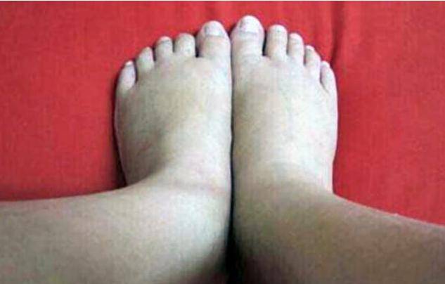 症状|尿毒症是“拖出来”的吗?提醒:身上2处发臭,可能是肾脏在呼救