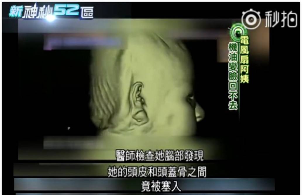因为女星韩慧景：为了更漂亮，给脸注射食用油，把脸整成“猪头”