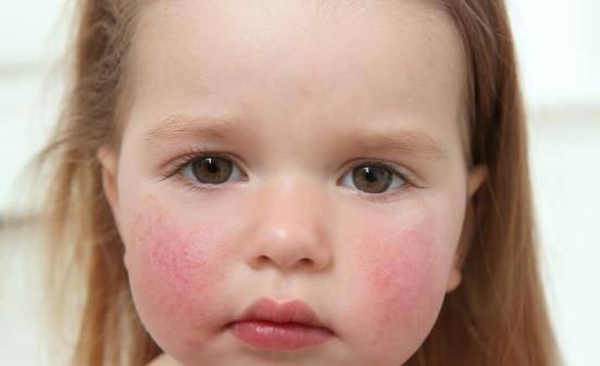 原创生活中最常见的三种敏感肌小心点别真搞成了敏感肌