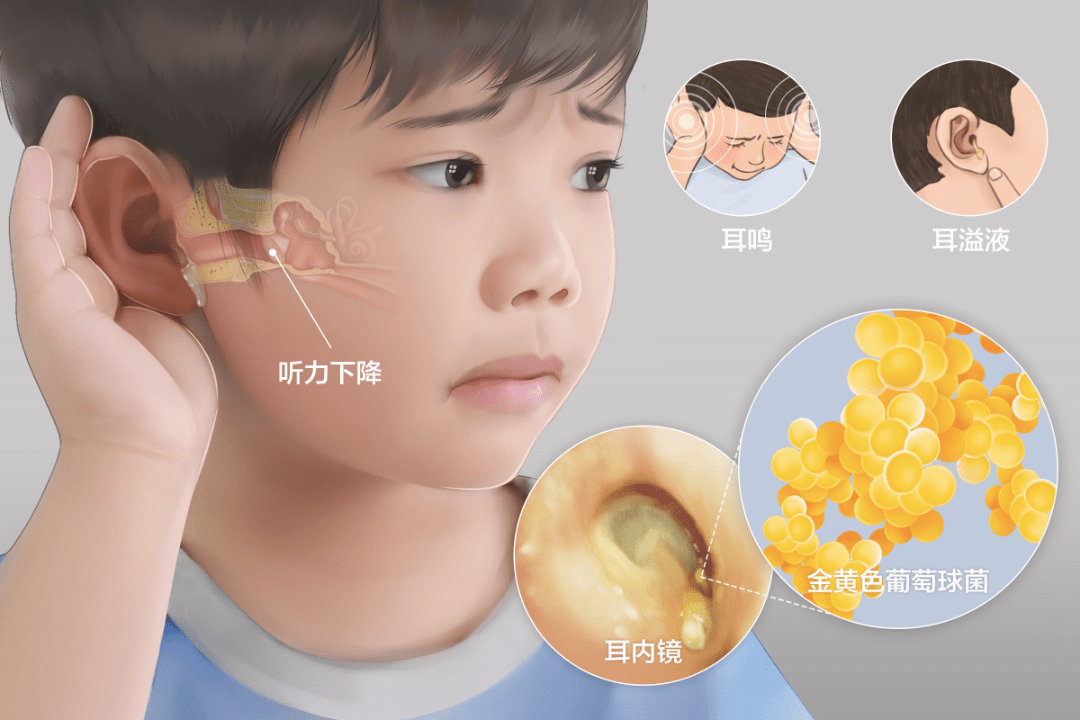 中耳炎拖延成脑脓肿孩子感冒后两个动作要警惕