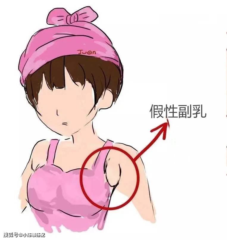 乳房假性发育图片