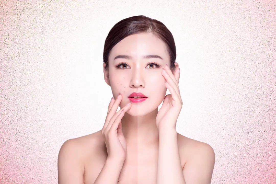 波长涨点医美知识 | 激光祛斑的常见问题
