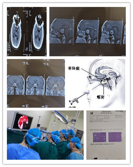 首例|西安市红会医院神经外科完成院首例经鼻蝶神经内镜下垂体瘤切除术