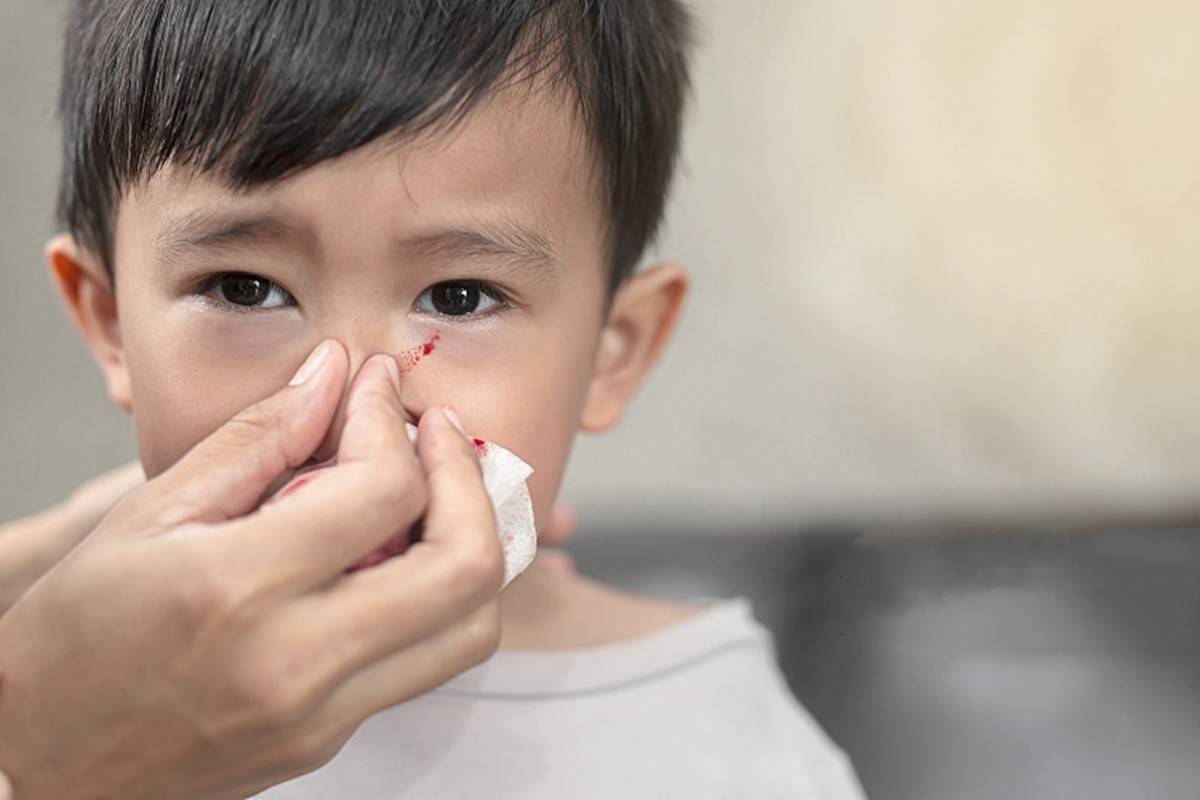 孩子流鼻血怎么办 仰头 塞纸团都没用 正确的方法在这里快收藏 家长 情况 鼻腔