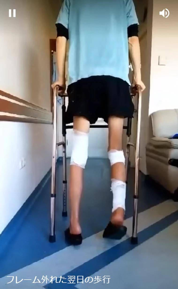 进行167身高太矮！日本男子忍痛进行“断腿手术”成功变身177帅哥