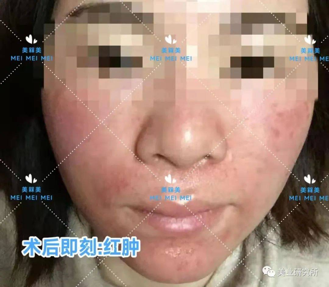 因为【美人汇】痘坑究竟该如何攻克？