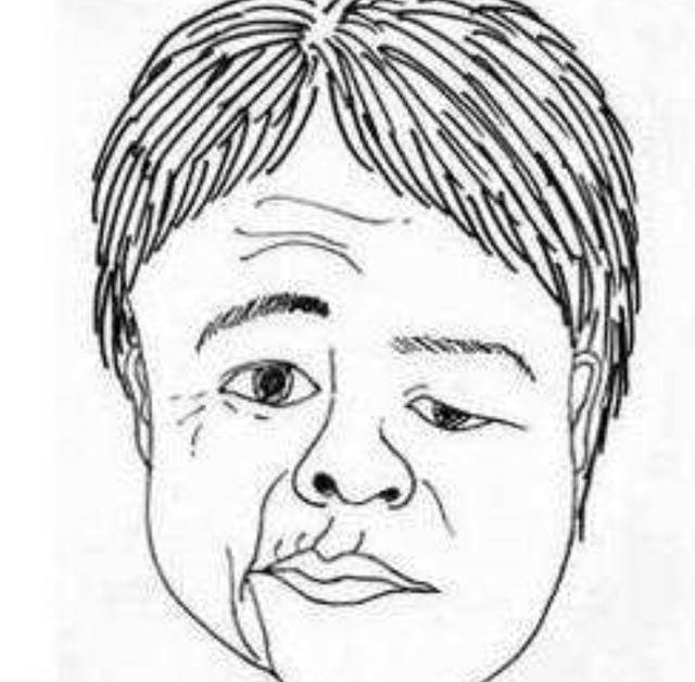 进行|舌肌麻痹由舌咽神经病变、髓内病变、舌神经损伤等引起,不会遗传