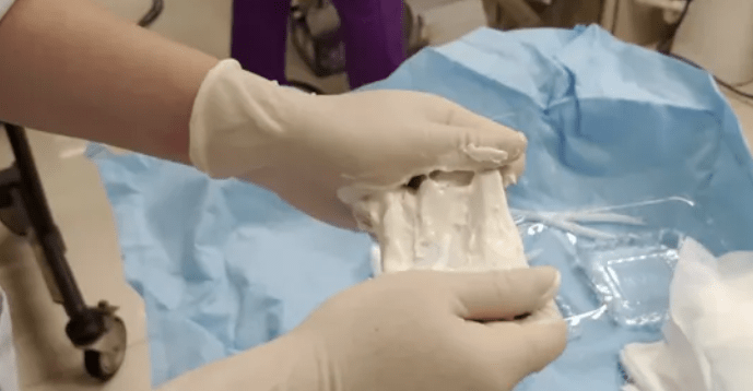 帝肤葆带你了解慢性窦道创面的治疗方法_组织_手术_细菌