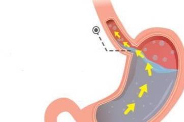 饮食|反酸、烧心，胃难受！中医认为分4种类型，3个饮食技巧缓解逆流