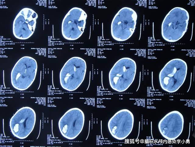 2岁儿童外伤脑出血术后脑积水伴颅内感染2月余,反复多次脑室引流并