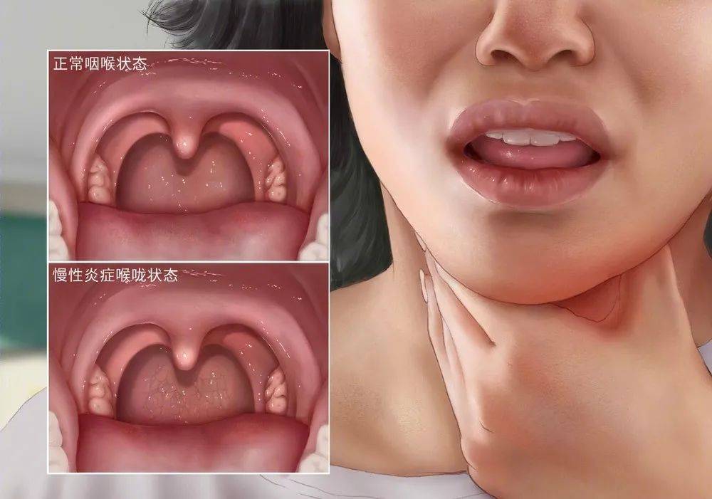 喉部在解剖位置上相互临近,黏膜相互延续,因此咽炎常与喉炎并称咽喉炎