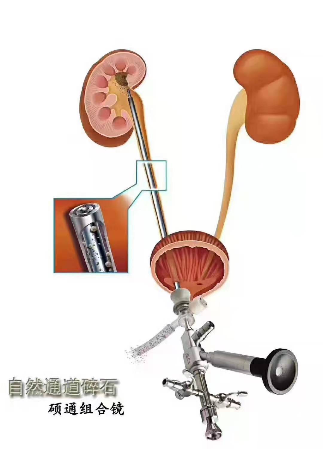 输尿管镜进镜技巧图片图片