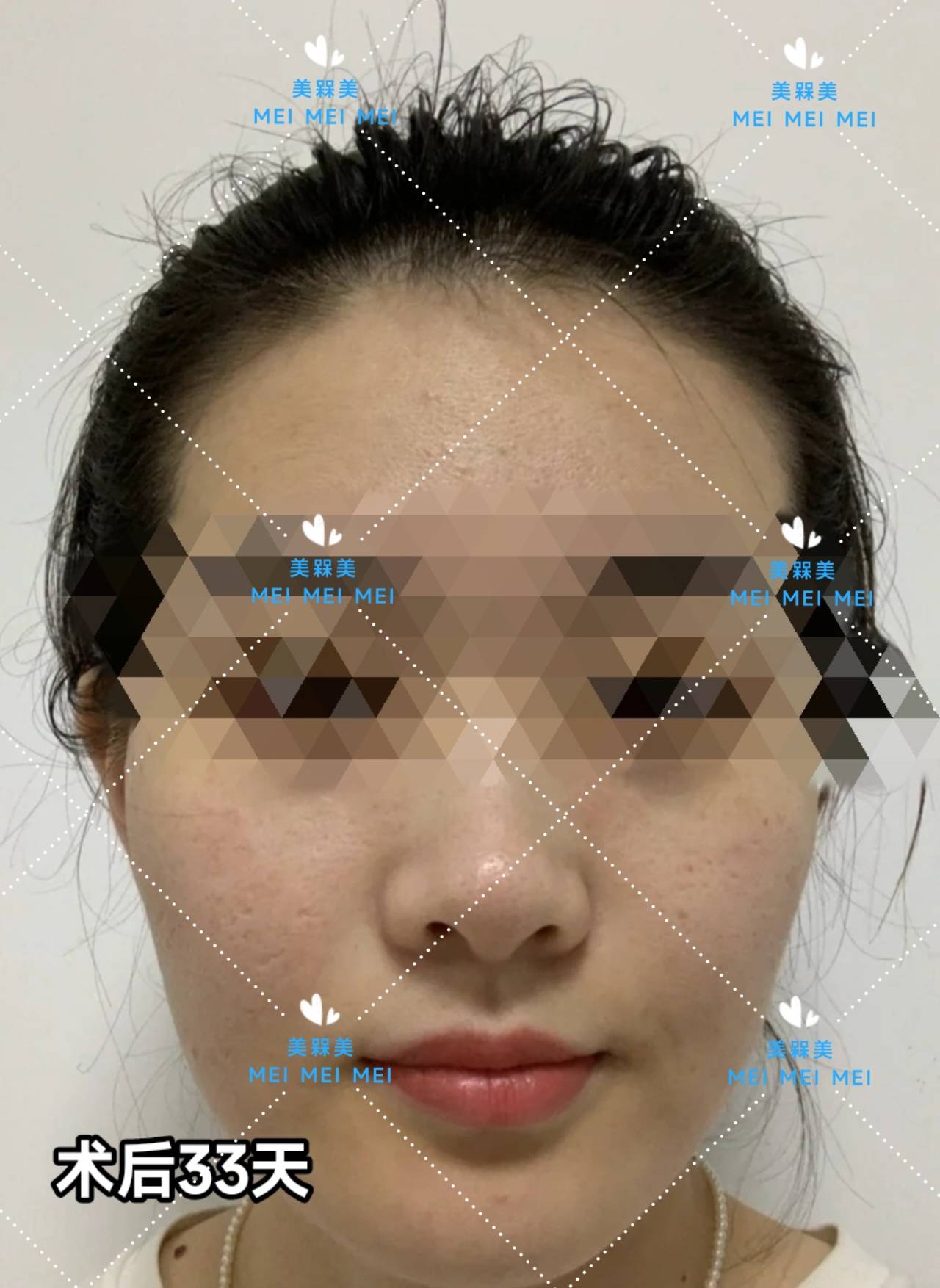 差不多【美人汇】痘痘肌少女的逆袭之路
