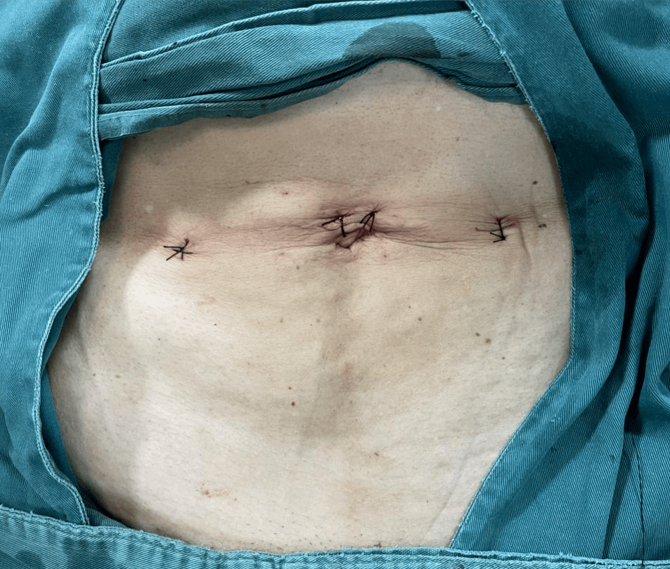 疝修补术后单孔腹腔镜手术中植入10x15厘米补片手术操作场景73岁的何