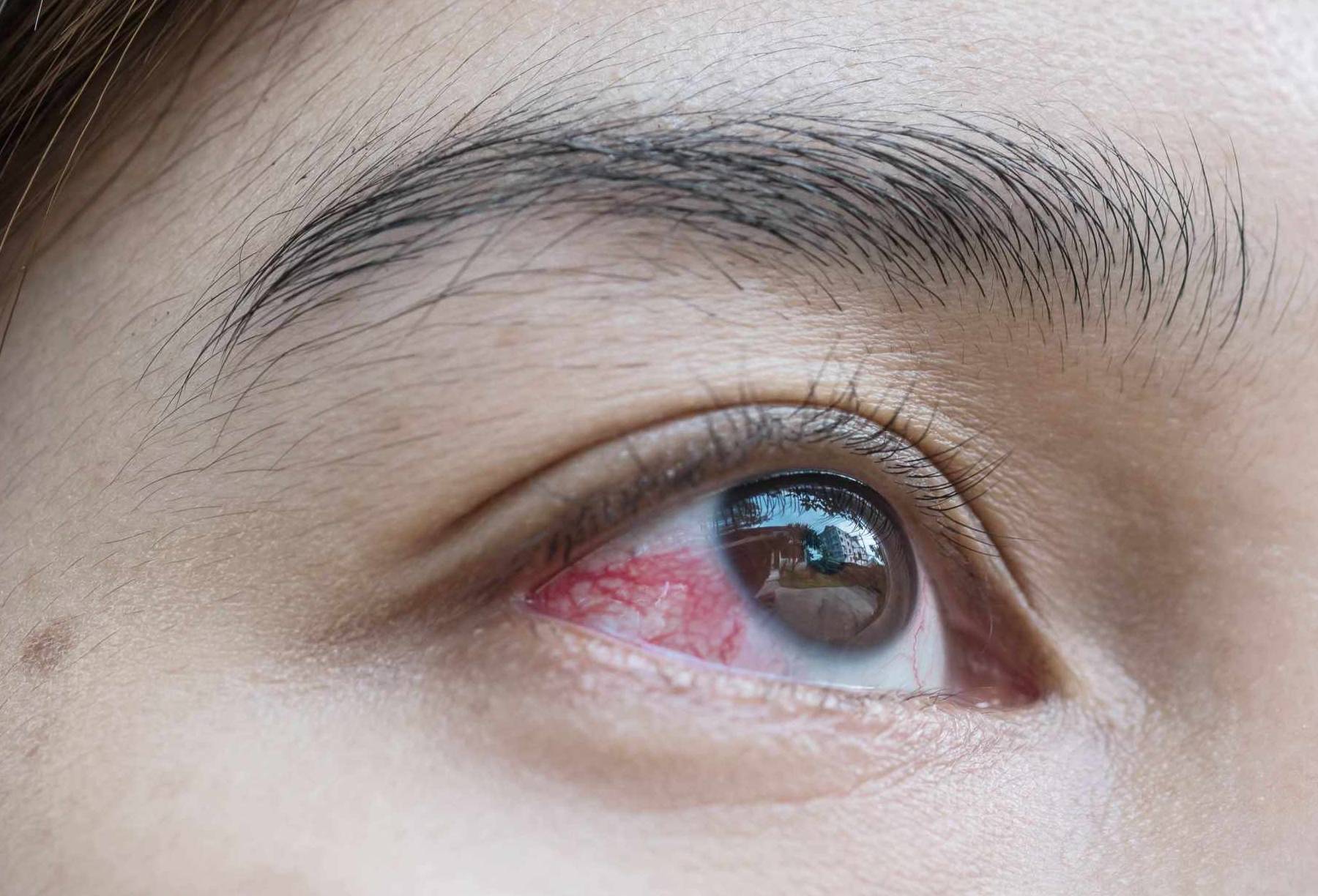 眼睛出现红血丝 中医怎么治？ | 眼睛血丝 | 红眼症 | 结膜炎 | 大纪元