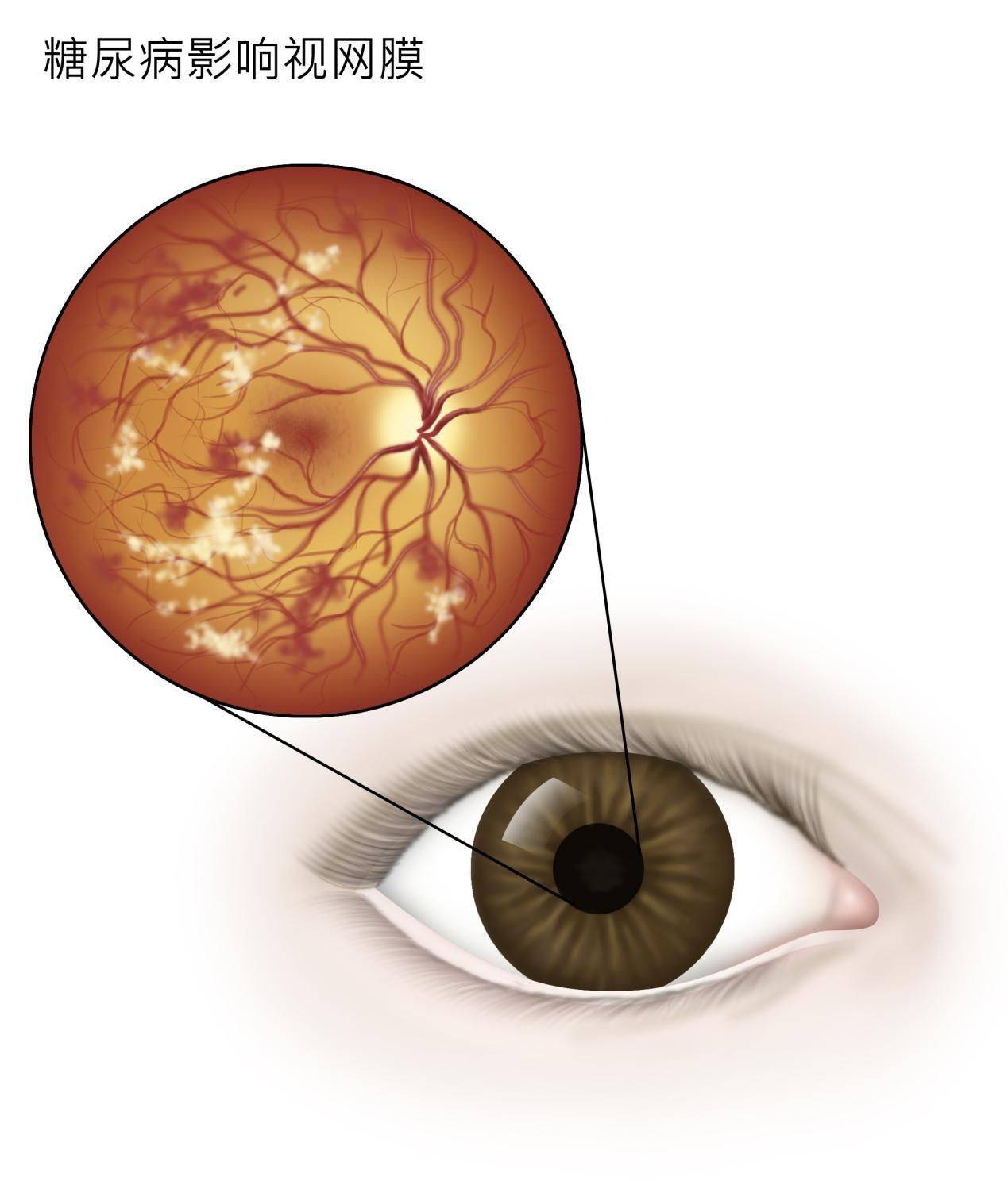 糖尿病眼病,不容忽视的"视力杀手"_病变_视网膜_检查