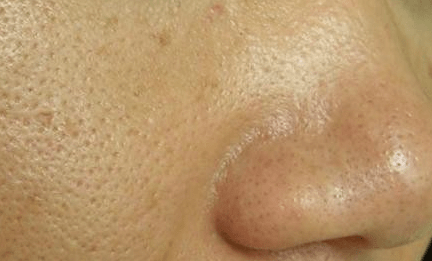 根据毛孔的类型,因油脂分泌过多造成的暂时性毛孔粗大,在清洁去除角质