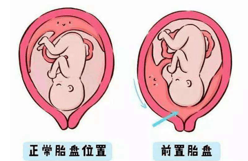 卵巢囊肿b超图图片