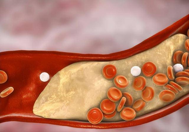胆固醇“大户”被揪出，不是猪大肠，医生：尽量少碰，避免脑梗
