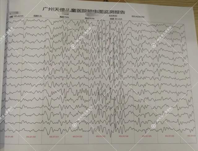 脑电图报告单图片图片