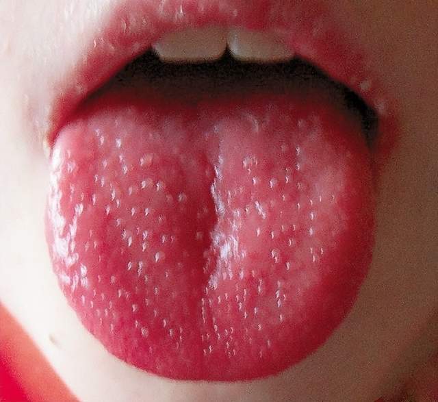 舌头上有红色的小肉粒图片