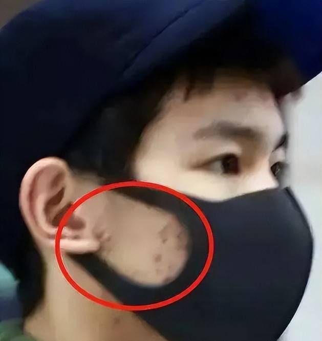 即使他戴着口罩,也无法掩饰脸上的坑坑洼洼,就像月球表面一样
