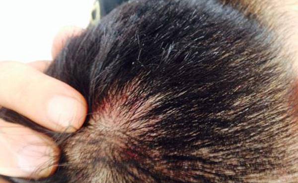 头发中的硬包是什么?可能和3种原因有关,你需要了解_头部_头皮_洗头